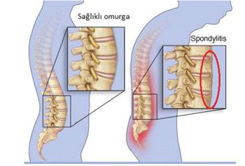 ANKİLOZAN SPONDİLİT